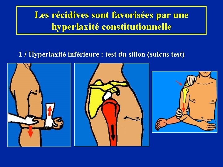 Les récidives sont favorisées par une hyperlaxité constitutionnelle 1 / Hyperlaxité inférieure : test