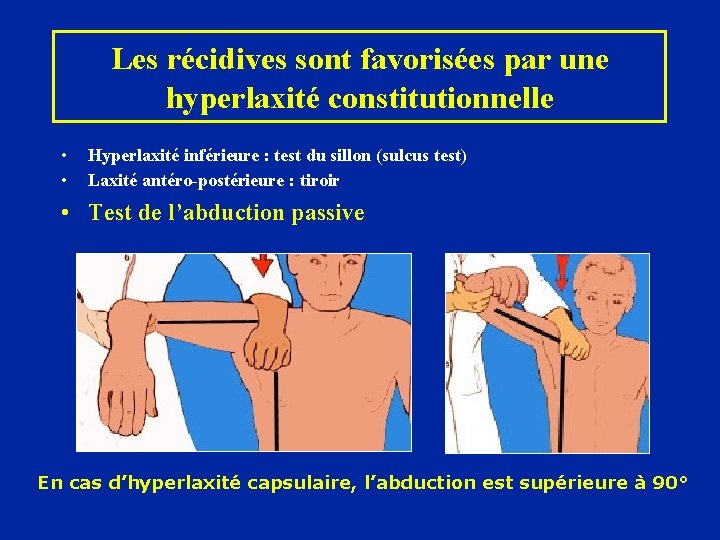 Les récidives sont favorisées par une hyperlaxité constitutionnelle • • Hyperlaxité inférieure : test