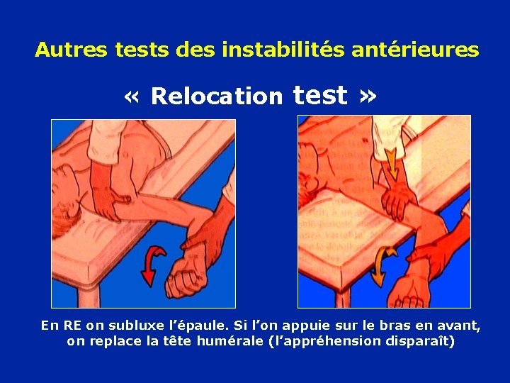 Autres tests des instabilités antérieures « Relocation test » En RE on subluxe l’épaule.