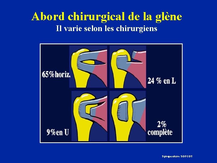 Abord chirurgical de la glène Il varie selon les chirurgiens Symposium SOFCOT 