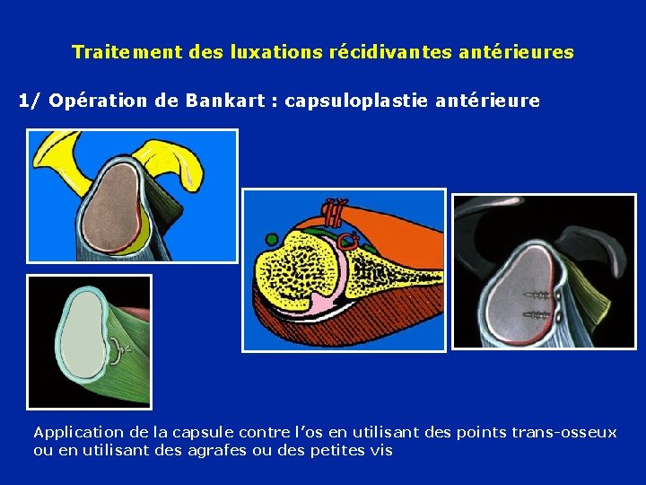 Traitement des luxations récidivantes antérieures 1/ Opération de Bankart : capsuloplastie antérieure Application de