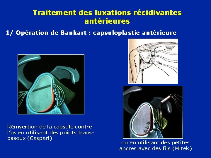 Traitement des luxations récidivantes antérieures 1/ Opération de Bankart : capsuloplastie antérieure Réinsertion de