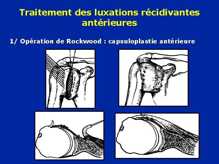 Traitement des luxations récidivantes antérieures 1/ Opération de Rockwood : capsuloplastie antérieure 