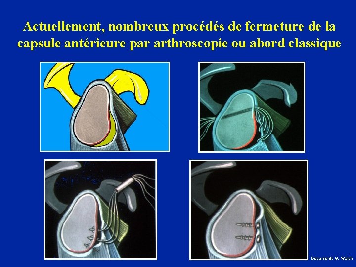 Actuellement, nombreux procédés de fermeture de la capsule antérieure par arthroscopie ou abord classique