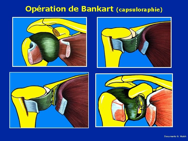 Opération de Bankart (capsuloraphie) Documents G. Walch 