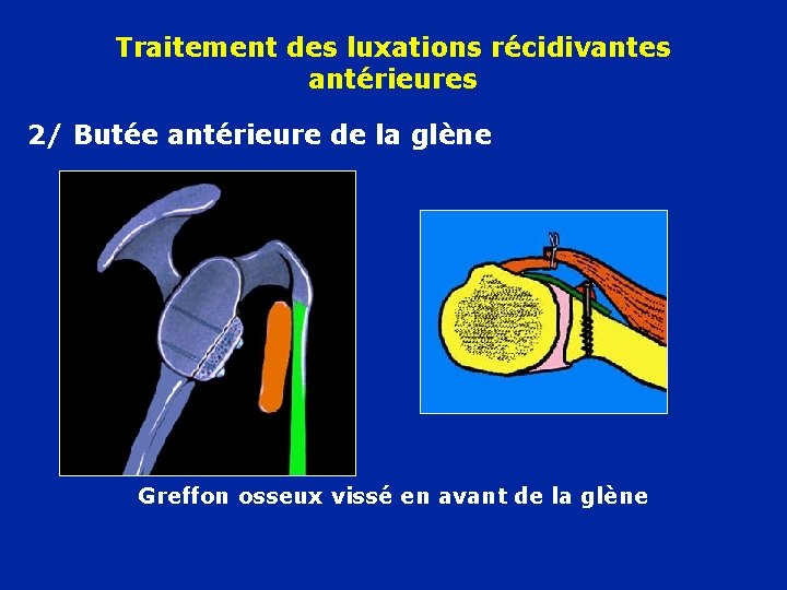 Traitement des luxations récidivantes antérieures 2/ Butée antérieure de la glène Greffon osseux vissé