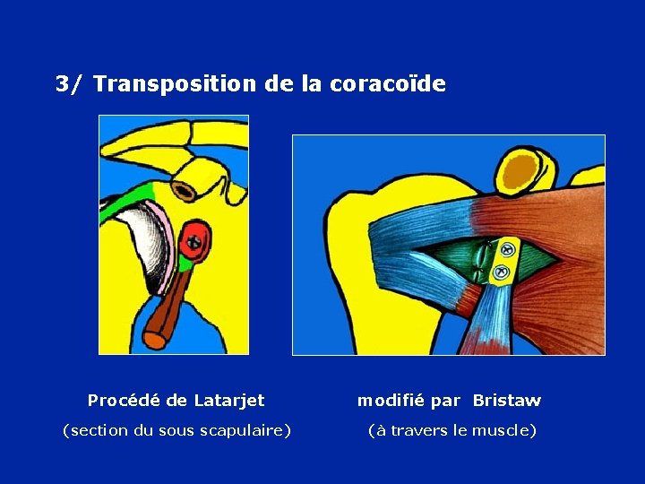 3/ Transposition de la coracoïde Procédé de Latarjet modifié par Bristaw (section du sous