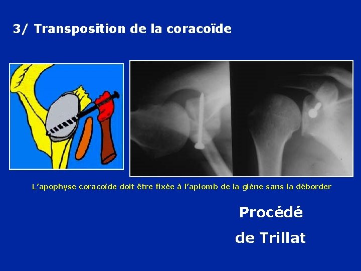 3/ Transposition de la coracoïde L’apophyse coracoïde doit être fixée à l’aplomb de la