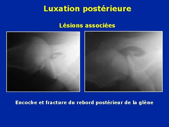 Luxation postérieure Lésions associées Encoche et fracture du rebord postérieur de la glène 