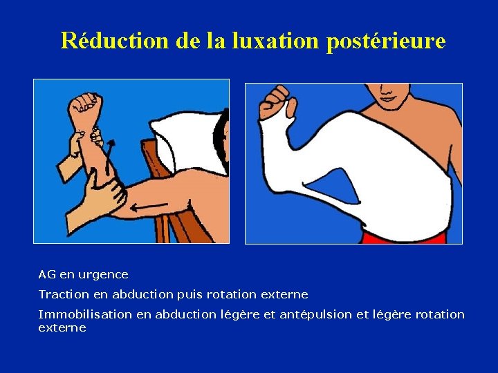 Réduction de la luxation postérieure AG en urgence Traction en abduction puis rotation externe