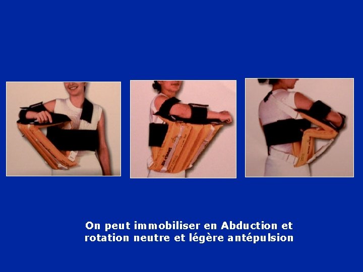 On peut immobiliser en Abduction et rotation neutre et légère antépulsion 