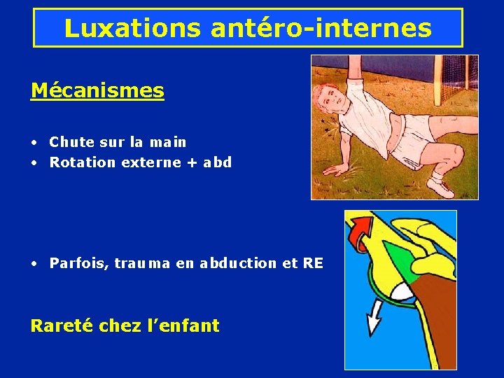 Luxations antéro-internes Mécanismes • Chute sur la main • Rotation externe + abd •