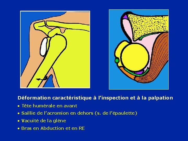 Déformation caractéristique à l’inspection et à la palpation • Tête humérale en avant •