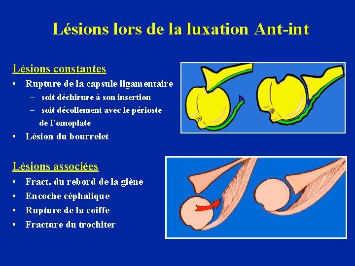 Lésions lors de la luxation Ant-int Lésions constantes • Rupture de la capsule ligamentaire