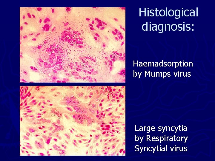 Histological diagnosis: Haemadsorption by Mumps virus Large syncytia by Respiratory Syncytial virus Histological diagnosis: Haemadsorption by Mumps virus Large syncytia by Respiratory Syncytial virus