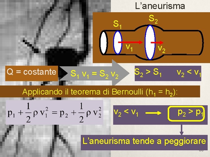 L’aneurisma S 2 S 1 v 1 Q = costante S 1 v 1