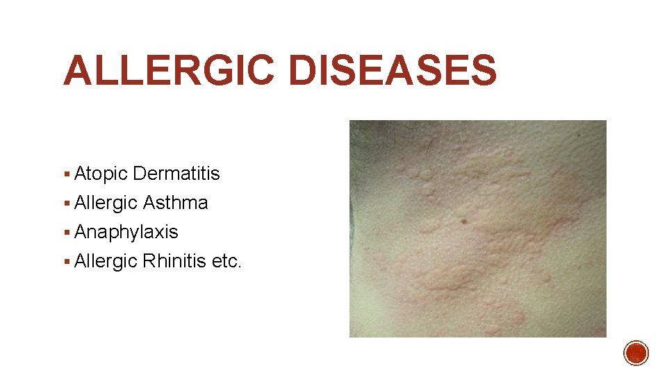 ALLERGIC DISEASES § Atopic Dermatitis § Allergic Asthma § Anaphylaxis § Allergic Rhinitis etc.