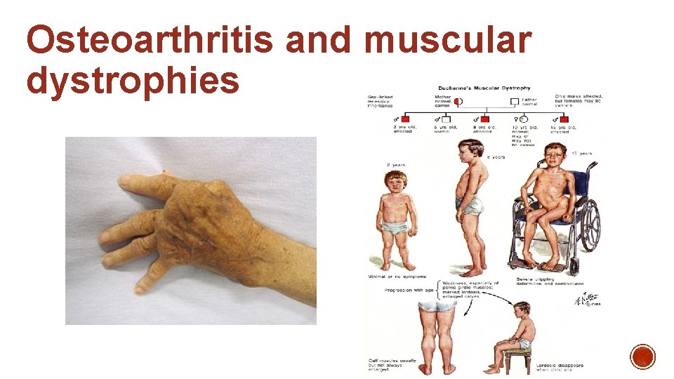 Osteoarthritis and muscular dystrophies 