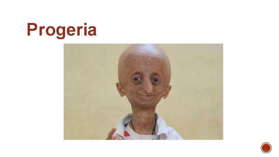 Progeria 