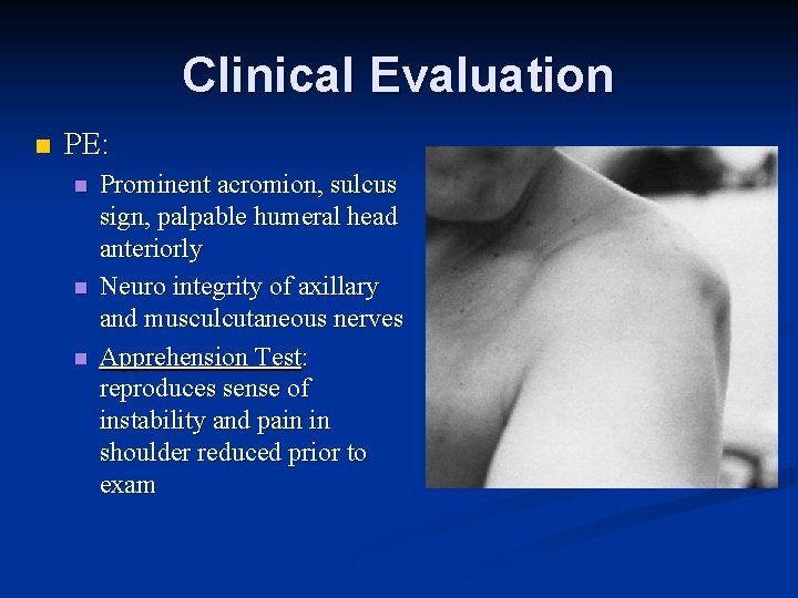 Clinical Evaluation n PE: n n n Prominent acromion, sulcus sign, palpable humeral head