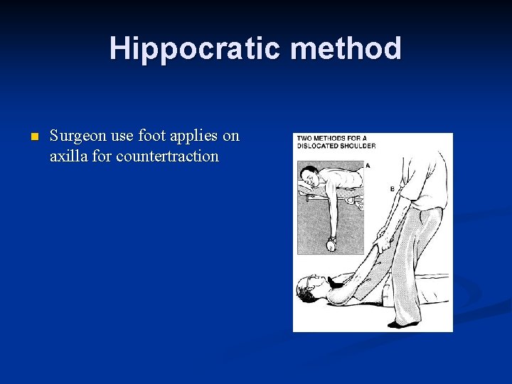 Hippocratic method n Surgeon use foot applies on axilla for countertraction 
