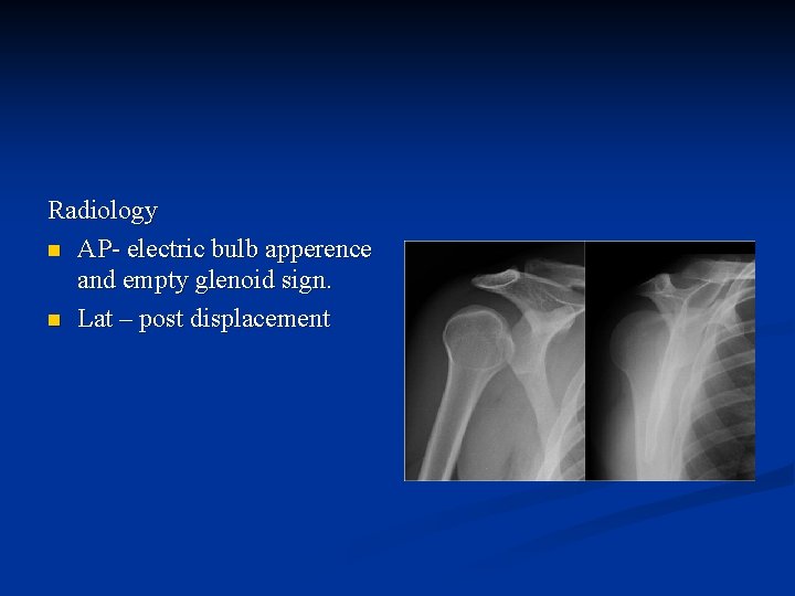 Radiology n AP- electric bulb apperence and empty glenoid sign. n Lat – post