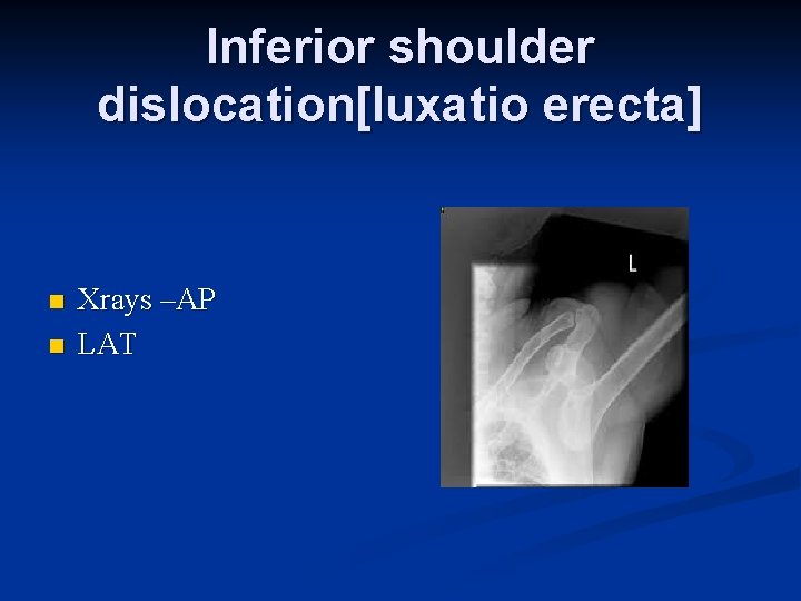 Inferior shoulder dislocation[luxatio erecta] n n Xrays –AP LAT 