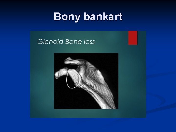 Bony bankart 