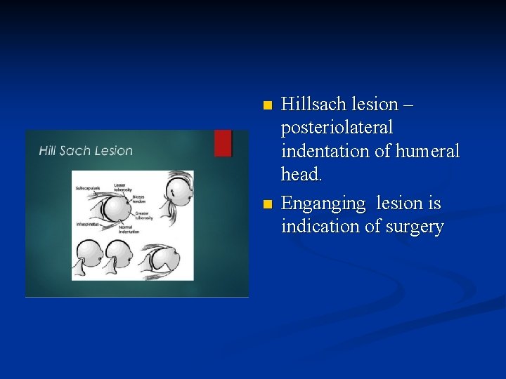 n n Hillsach lesion – posteriolateral indentation of humeral head. Enganging lesion is indication