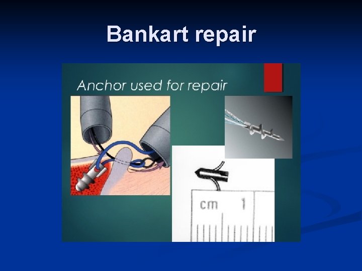Bankart repair 