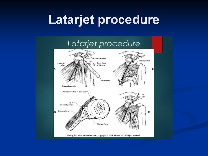 Latarjet procedure 