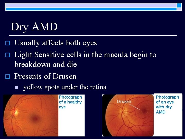 Dry AMD o o o Usually affects both eyes Light Sensitive cells in the