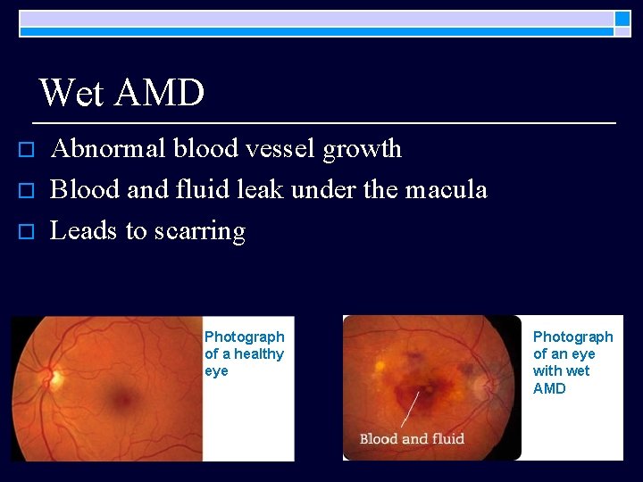 Wet AMD o o o Abnormal blood vessel growth Blood and fluid leak under Wet AMD o o o Abnormal blood vessel growth Blood and fluid leak under