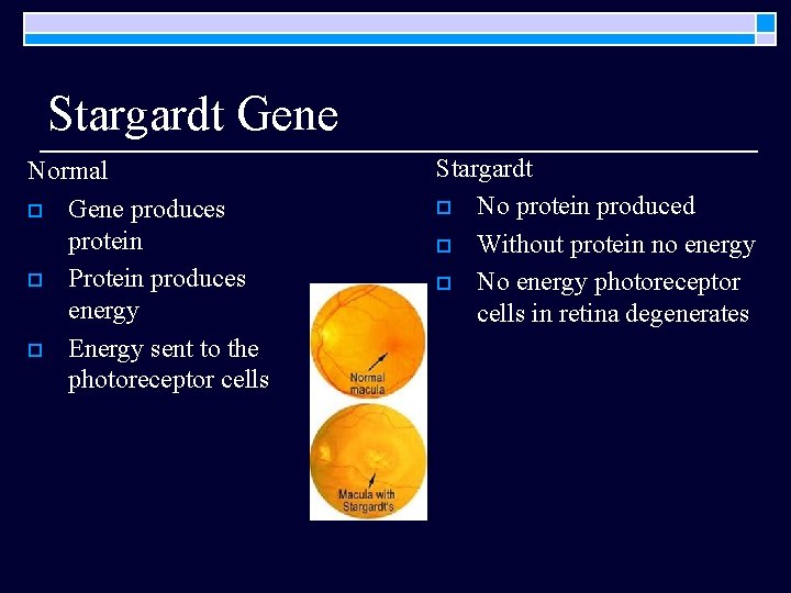 Stargardt Gene Normal o Gene produces protein o Protein produces energy o Energy sent