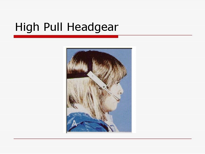 High Pull Headgear 