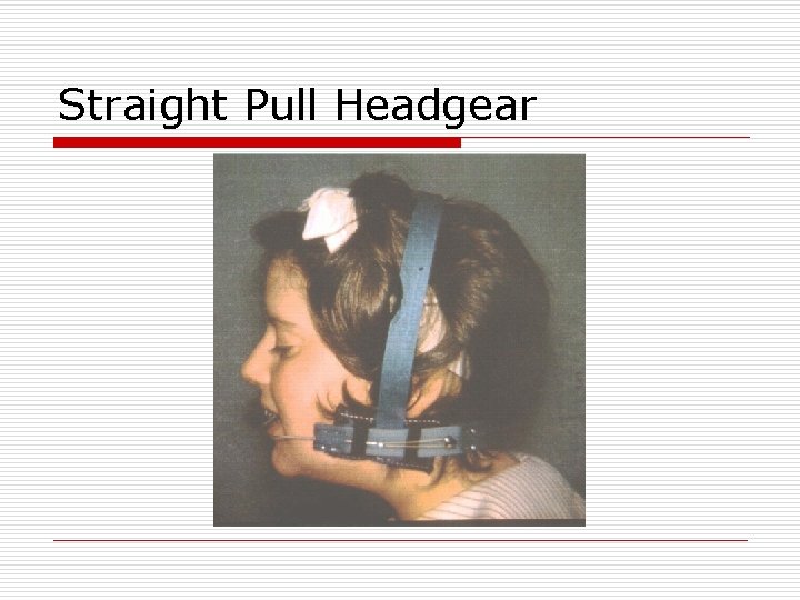 Straight Pull Headgear 