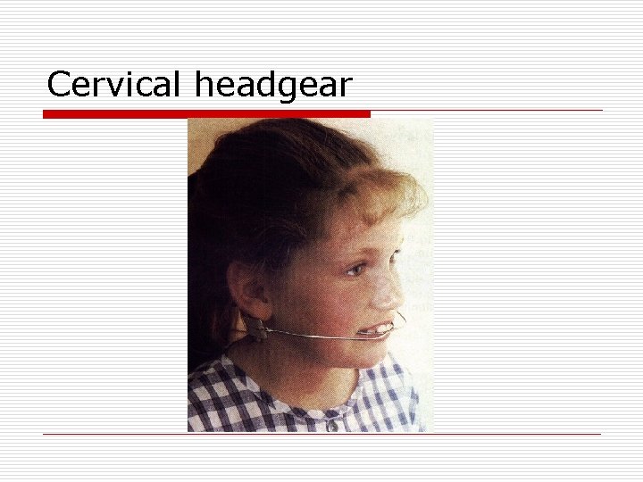Cervical headgear 