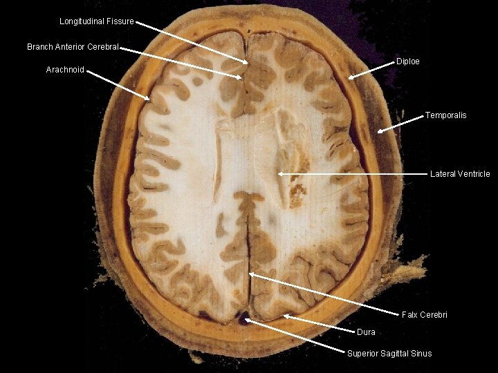 Longitudinal Fissure Branch Anterior Cerebral Diploe Arachnoid Temporalis Lateral Ventricle Falx Cerebri Dura Superior