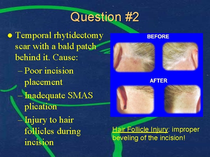 Question #2 l Temporal rhytidectomy scar with a bald patch behind it. Cause: –