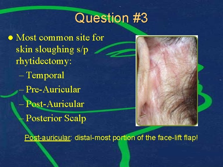 Question #3 l Most common site for skin sloughing s/p rhytidectomy: – Temporal –