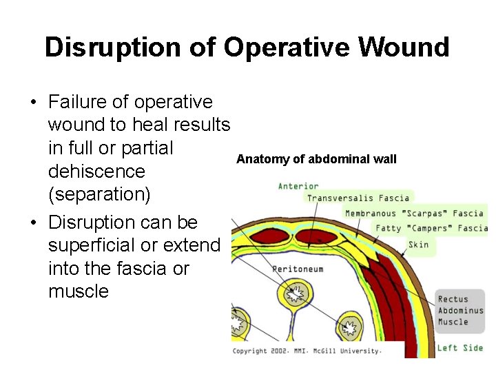 Disruption of Operative Wound • Failure of operative wound to heal results in full Disruption of Operative Wound • Failure of operative wound to heal results in full
