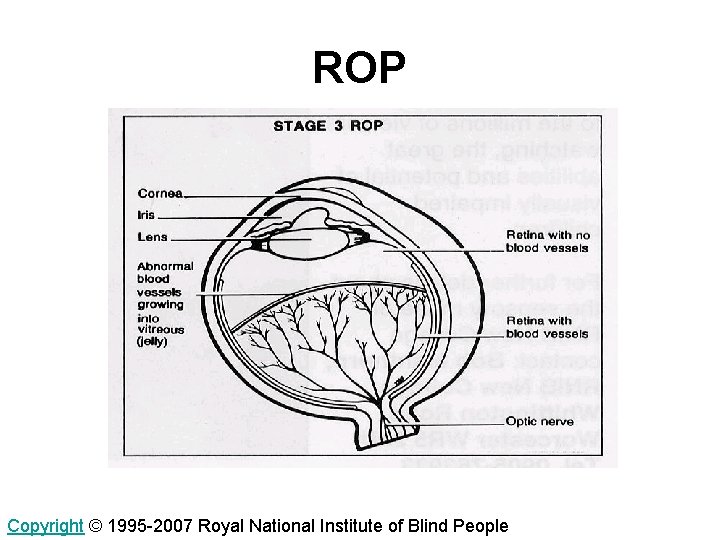 ROP Copyright © 1995 -2007 Royal National Institute of Blind People 