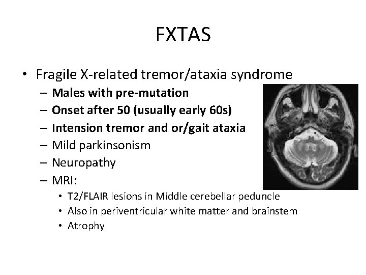 FXTAS • Fragile X-related tremor/ataxia syndrome – Males with pre-mutation – Onset after 50