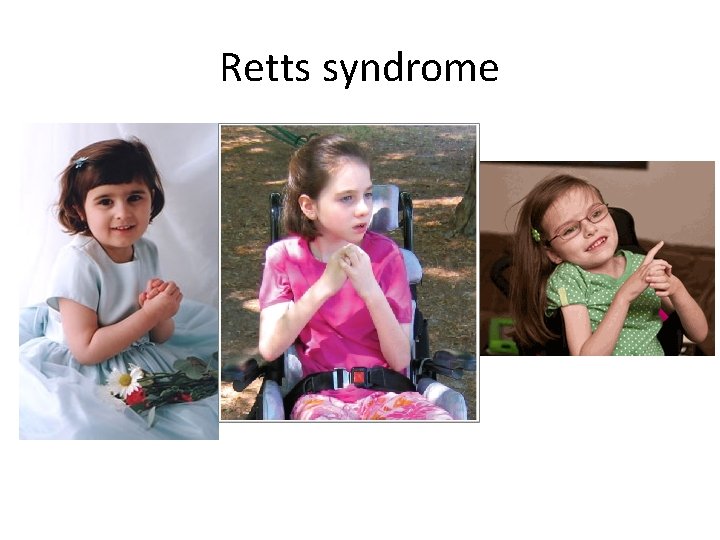 Retts syndrome 