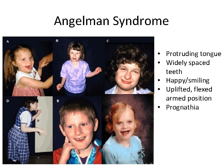 Angelman Syndrome • Protruding tongue • Widely spaced teeth • Happy/smiling • Uplifted, flexed