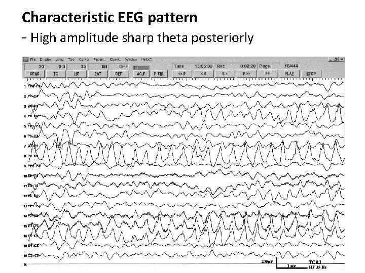 Characteristic EEG pattern - High amplitude sharp theta posteriorly 