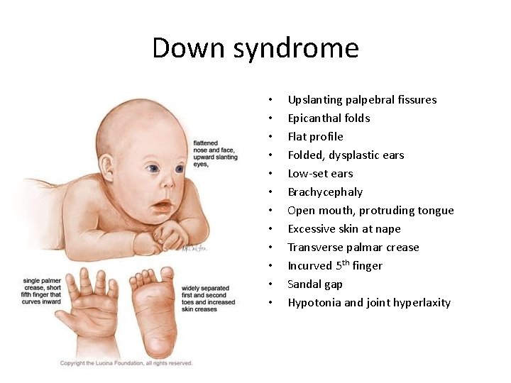 Down syndrome • • • Upslanting palpebral fissures Epicanthal folds Flat profile Folded, dysplastic