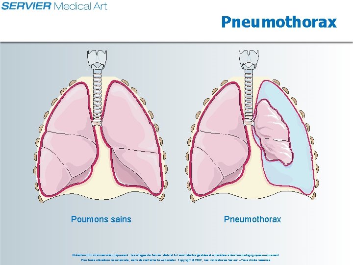 Pneumothorax Poumons sains Pneumothorax Utilisation non commerciale uniquement. Les images de Servier Medical Art