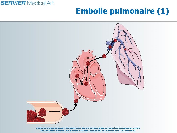 Embolie pulmonaire (1) Utilisation non commerciale uniquement. Les images de Servier Medical Art sont