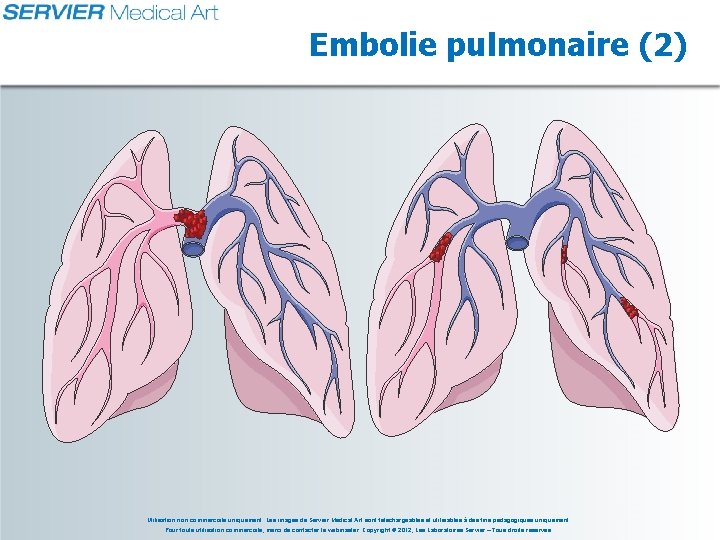 Embolie pulmonaire (2) Utilisation non commerciale uniquement. Les images de Servier Medical Art sont